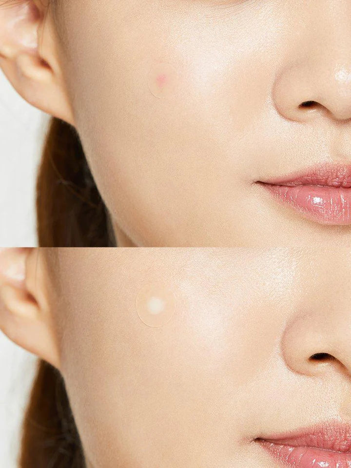 COSRX Acne Pimple Master Patch before and after patch use